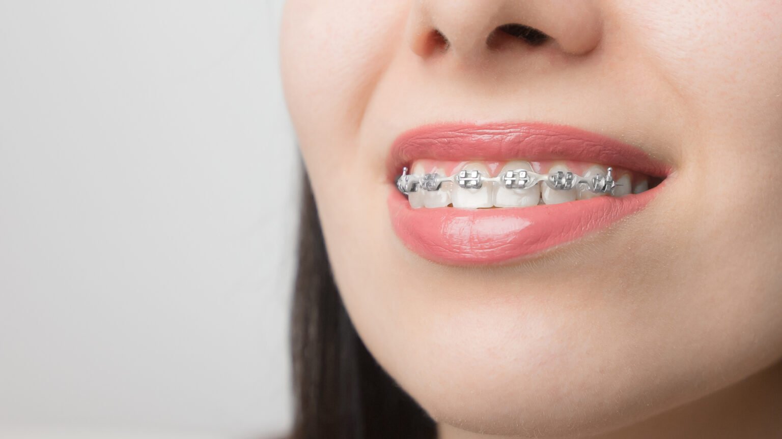 ¿Qué son los brackets estéticos? ⋆ Ikigai Dental